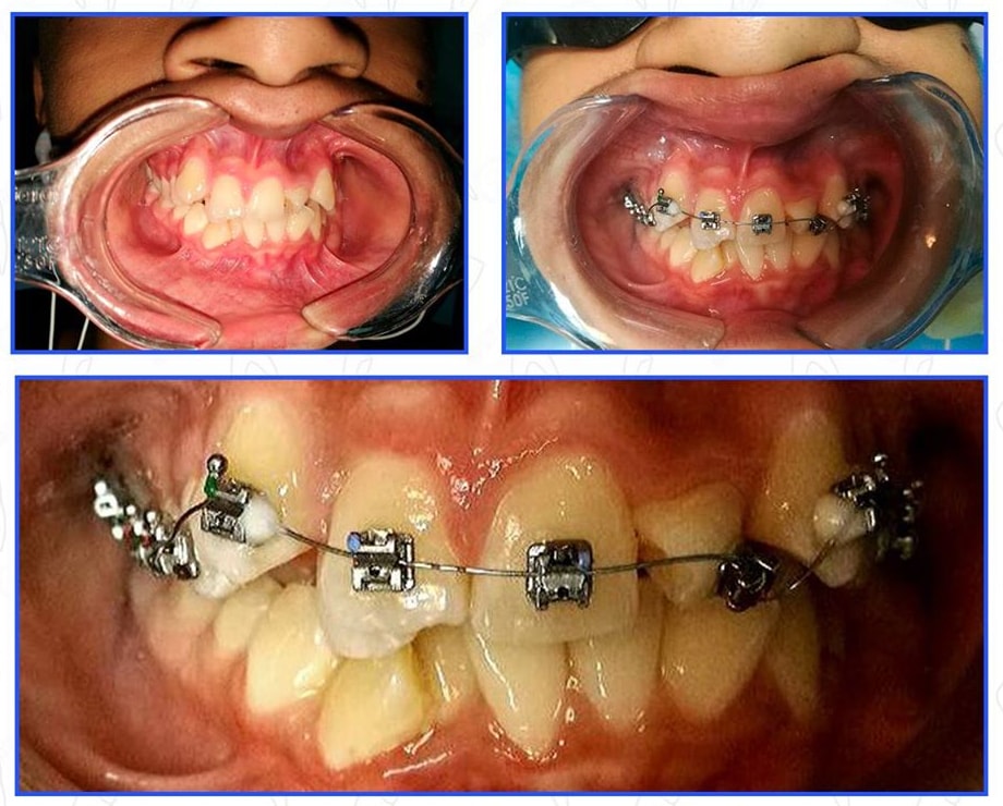 Caso de ortodoncia: colocación de brackets