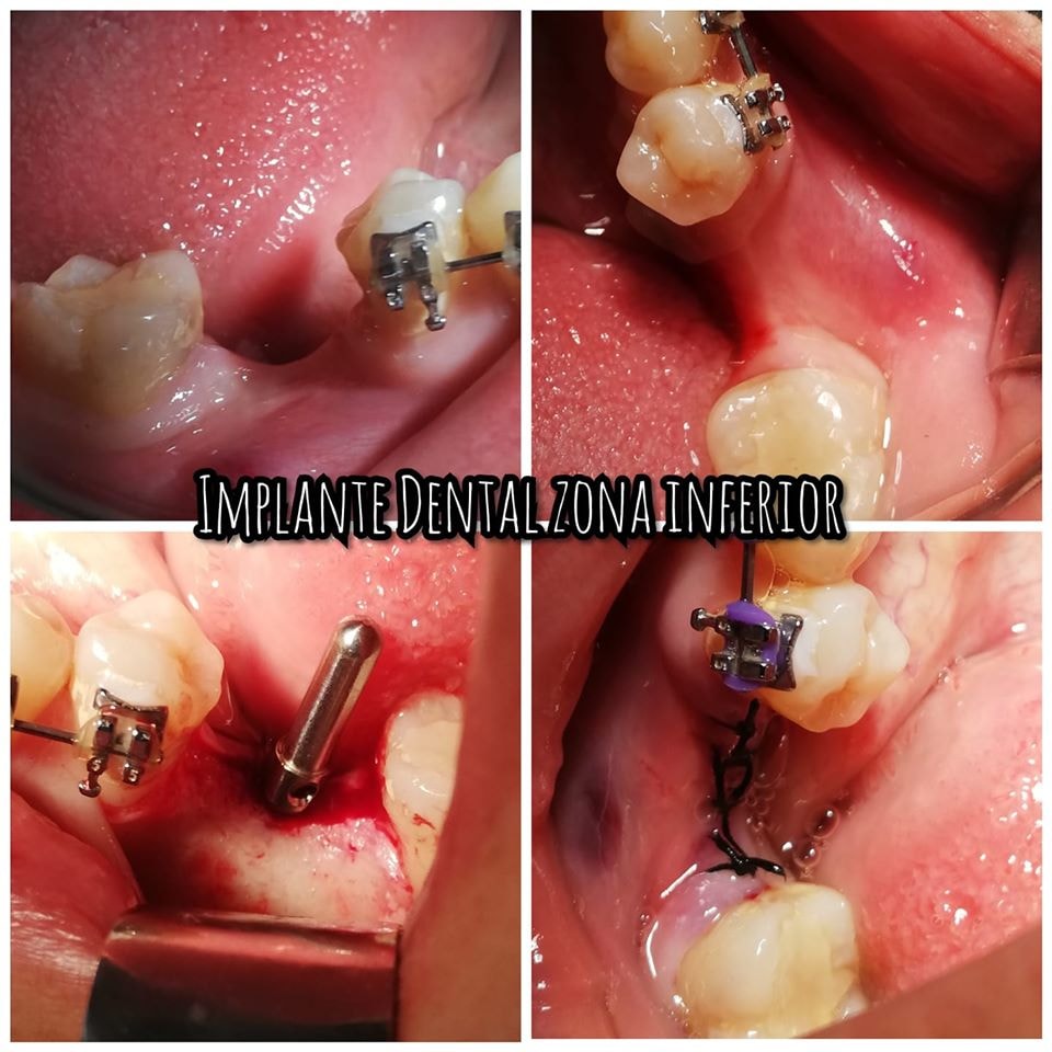 Seguimiento de un caso de brackets