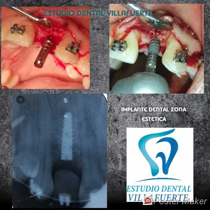 Detalle de un tratamiento de ortodoncia
