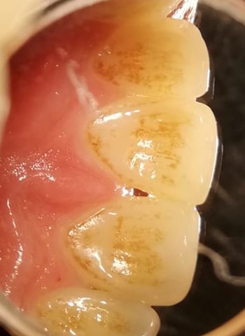 Dientes con manchas y sarro antes de la limpieza