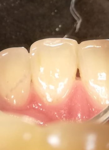 Los mismos dientes limpios tras la profilaxis